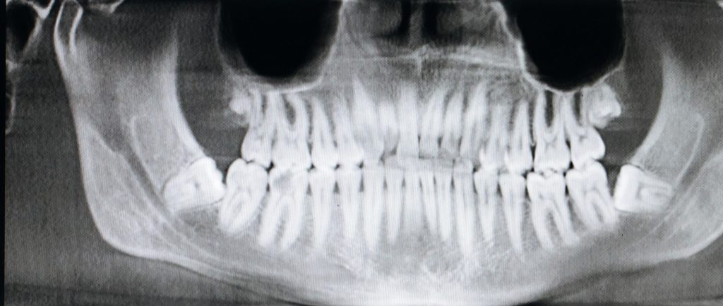 quando-togliere-dente-del-giudizio